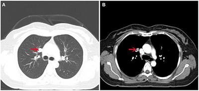 Case Report: Benign Uterine Adenomyoma Metastasis in the Right Lung